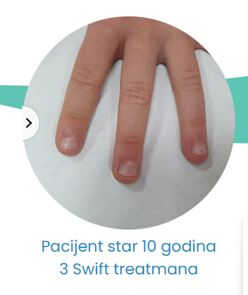 3 swift tretmana poslije 10 godina