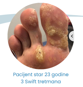 3 swift tretmana prije